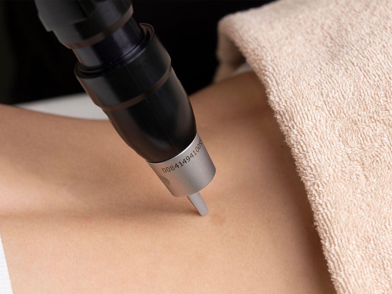 Pico laser treatment at Glowvia